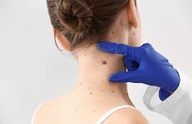 skin tag removal dubai