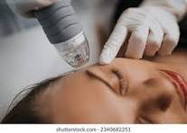 microneedling in dubai