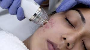 pimple scar treatment in dubai